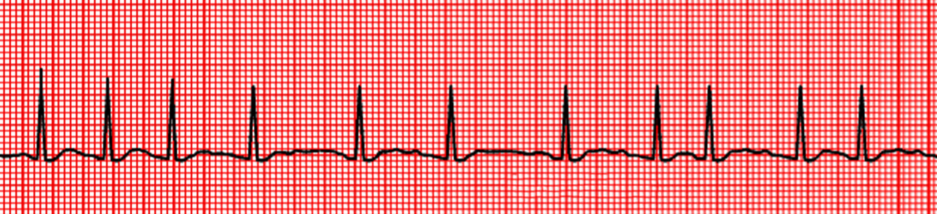 Dr. Sujata S. Balulad  Atrial Fibrillation Banner