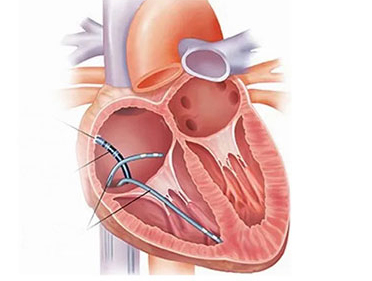 Ablation Image