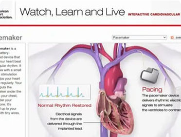 Pacemaker Implantation Image