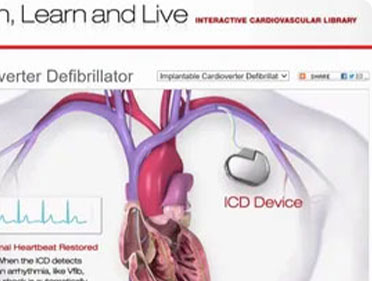 ICD Implantation Image