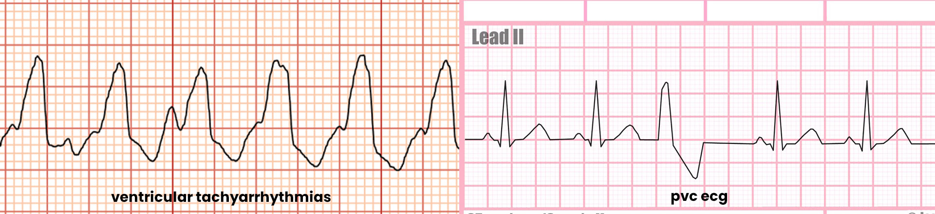 Dr. Sujata S. Balulad  Ventricular Arrhythmia Banner